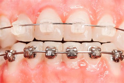 diferencia brackets esteticos y metalicos|champagne vs metal braces.